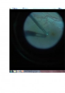 Qvision ¿Qué es la cromovitrectomía? MLI 2 0000