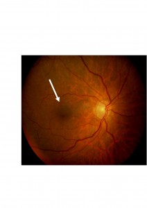 Qvision Nuestra experiencia en el tratamiento de la membrana epirretiniana mer postQ 0000