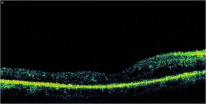 Qvision El edema macular diabético y la interfase vítreo-macular EMD TR 3
