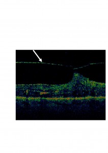 Qvision El edema macular diabético y la interfase vítreo-macular EMD TRACCIONAL 1 0000