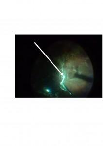 Qvision El edema macular diabético y la interfase vítreo-macular EMD TRACCIONAL 2 00001