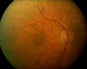 Qvision ¿Cómo tratamos el síndrome de tracción vítreo-macular? SDE TVM PREQ 2