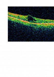 Qvision ¿Cómo podemos ayudar a los pacientes afectados de retinosis pigmentaria? OCT RP 0000