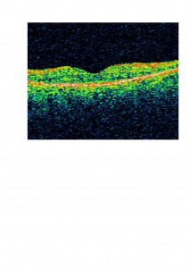 Qvision ¿Cómo podemos ayudar a los pacientes afectados de retinosis pigmentaria? OCT postto 3 0000