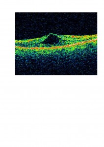 Qvision ¿Cómo podemos ayudar a los pacientes afectados de retinosis pigmentaria? OCT postto2 0000