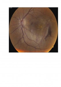 Qvision Degeneración macular asociada a la edad (DMAE) y Baja visión (I) DMAE 1 0000