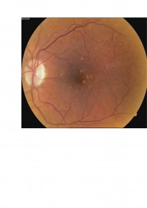 Qvision Degeneración macular asociada a la edad (DMAE) y Baja visión (II) DRUSAS 00002