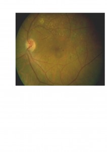 Qvision Retinopatía diabética y Baja visión (II) EMD 2 0000