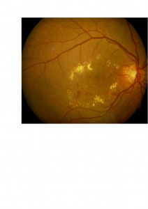 Qvision Retinopatía diabética y Baja visión (II) EMD 3 00001