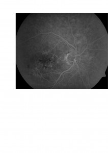 Qvision Retinopatía diabética y Baja visión (II) EMD 4 0000