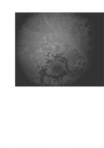 Qvision Retinopatía diabética y Baja visión (II) EMD 5 0000