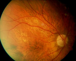 Qvision Maculopatía miópica y Baja visión (II). Agujero macular miópico. AGUJERO MIOPCO 1