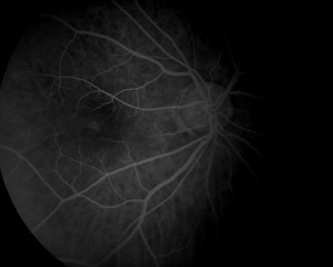 Qvision Maculopatía miópica y Baja visión (II). Agujero macular miópico. AGUJERO MIOPICO 2
