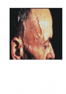 Qvision Pruebas de laboratorio para el diagnóstico precoz de arteritis de células gigantes. ACG 2 0000