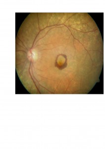 Qvision Dietas ricas en colesterol podrían tener relación con la degeneración macular asociada a la edad. DMAE 0000