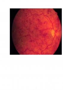 Qvision La aspirina y antiagregantes plaquetarios pueden ser desaconsejables en pacientes afectados de oclusion venosa retiniana. OVCR 0000