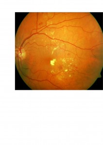 Qvision Aflibercept: un nuevo fármaco para el tratamiento del edema macular diabético. EMD 0000