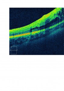 Qvision Las cámaras panretinianas (Optomap plus) permiten la detección del desprendimiento de retina con gran precisión. RETINOSQUISIS OCT 0000