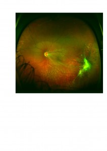Qvision Las cámaras panretinianas (Optomap plus) permiten la detección del desprendimiento de retina con gran precisión. retinosquisis 0000