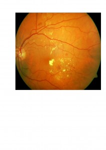 Qvision Los programas de prevención de la retinopatía diabética en el momento actual. RD 0000