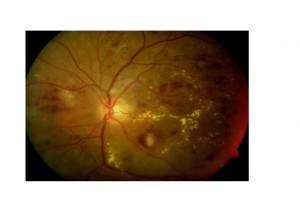 Qvision Ruboxistaurina como tratamiento de la retinopatía diabética. EM 1 0000