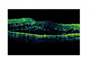 Qvision Ruboxistaurina como tratamiento de la retinopatía diabética. EM 2 0000