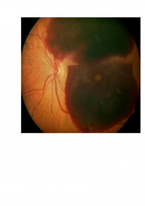 Qvision Anticoagulantes y antiagregantes plaquetarios en pacientes diabéticos sometidos a vitrectomía. HV 00001