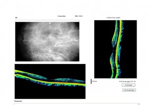 Qvision Ranibizumab como tratamiento de las telangiectasias maculares tipo 1. T 2 0000