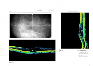 Qvision Ranibizumab como tratamiento de las telangiectasias maculares tipo 1. T1 0000