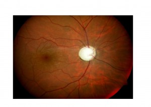 Qvision La vitrectomía puede incrementar el riesgo de padecer glaucoma. glaucoma 0000