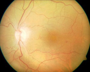 Qvision Ranibizumab como tratamiento de las telangiectasias maculares tipo 1. t1