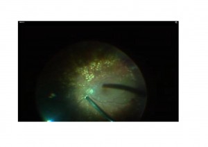 Qvision La vitrectomía puede incrementar el riesgo de padecer glaucoma. vitrectomia y glaucoma 0000