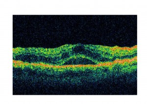Qvision Sirolimus podría ser efectivo como tratamiento del edema macular diabético. EMD OCT 00001