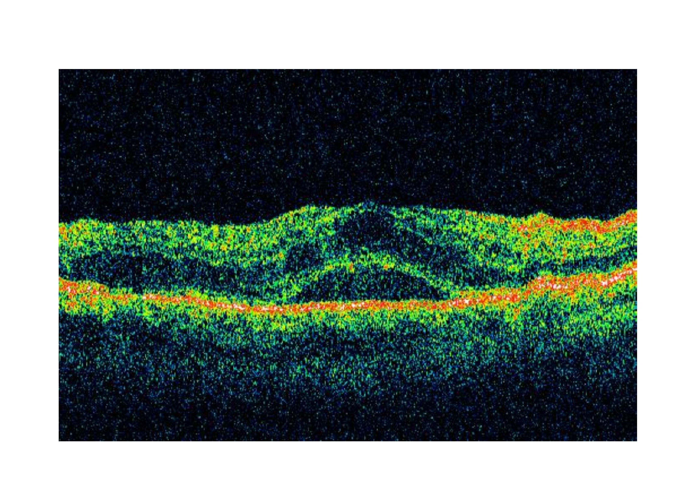 Qvision Tratamiento combinado en Edema Macular Diabético EMD OCT 00001