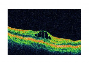 Qvision Importancia de la OCT en pacientes operados de desprendimiento de retina. post Q DR 1 0000