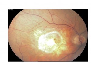 Qvision Los fármacos antiangiogénicos han reducido un 50% los casos de ceguera debida a degeneración macular asociada a la edad. DMAE 1 0000