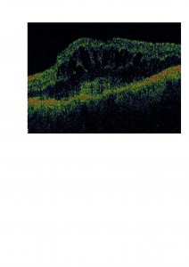 Qvision El colirio de bromfenac podría ser útil como coadyuvante en el tratamiento de la degeneración macular asociada a la edad. mns 0000