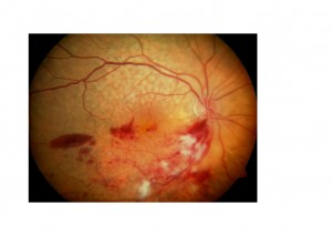 Qvision La apnea del sueño : un factor de riesgo para la trombosis venosa de la retina no descrito anteriormente. ovr 0000