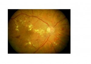 Qvision La longitud axial elevada protege de la retinopatía diabética y del edema macular. RD 1 0000