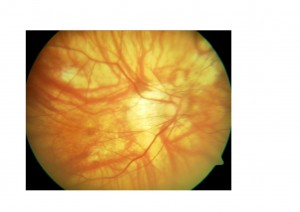 Qvision La longitud axial elevada protege de la retinopatía diabética y del edema macular. RM 0000