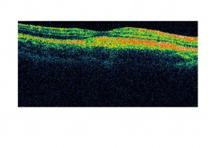 Qvision Hallazgo de nuevas mutaciones en la distrofia macular viteliforme de Best. Best 1 0000