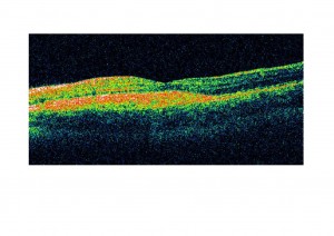 Qvision Hallazgo de nuevas mutaciones en la distrofia macular viteliforme de Best. Best 2 0000