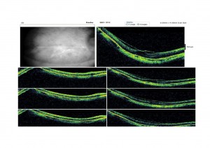 Qvision Indentación macular: un enfoque terapéutico distinto para la foveosquisis miópica. FOV 0000