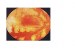 Qvision Ganciclovir intravítreo como tratamiento de la necrosis retiniana externa progresiva. NREp 1 0000