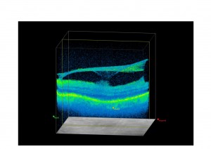 Qvision DMAE: la respuesta al tratamiento con antiangiogénicos puede verse modificada por el estado del vítreo adhesion v m 0000