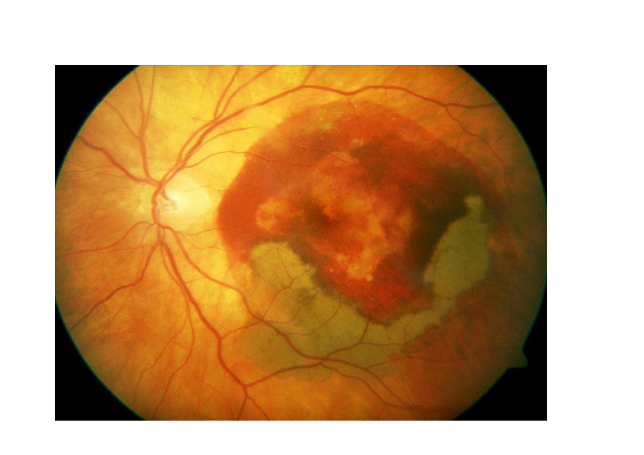 Qvision DMAE: la respuesta al tratamiento con antiangiogénicos puede verse modificada por el estado del vítreo nvc 0000