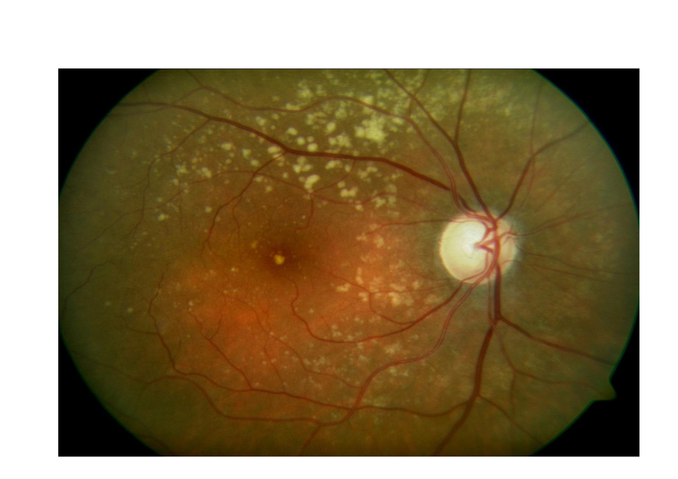 Qvision El tabaquismo induce la aparición de DMAE y su progresión. drusas 0000