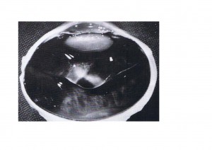 Qvision ¿Tratamiento quirúrgico, farmacológico o neumático para la tracción vítreo-macular? DVP COMPLETO ECO.docx 0000