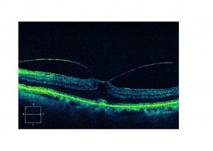 Qvision ¿Tratamiento quirúrgico, farmacológico o neumático para la tracción vítreo-macular? traccion v m 0000