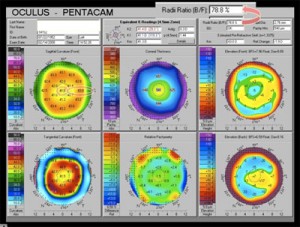 topografias pentacam